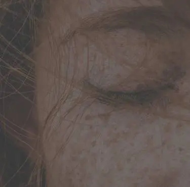 En personmed melasma i ansiktet