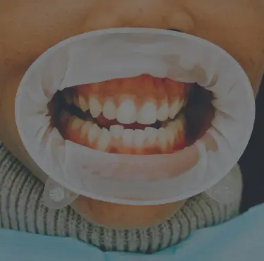 En person som har gummy smile.